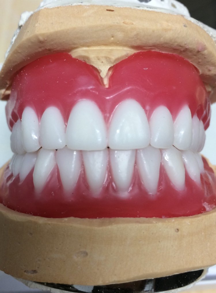 Immediate Dentures In Gold Coast Burleigh Denture Clinic