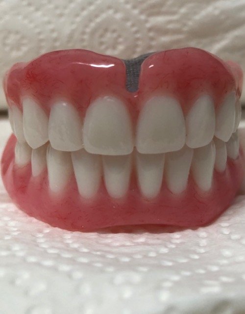 Immediate Dentures In Gold Coast Burleigh Denture Clinic