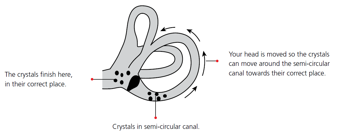 Vertigo or BPPV (Benign Paroxysmal Positional Vertigo)