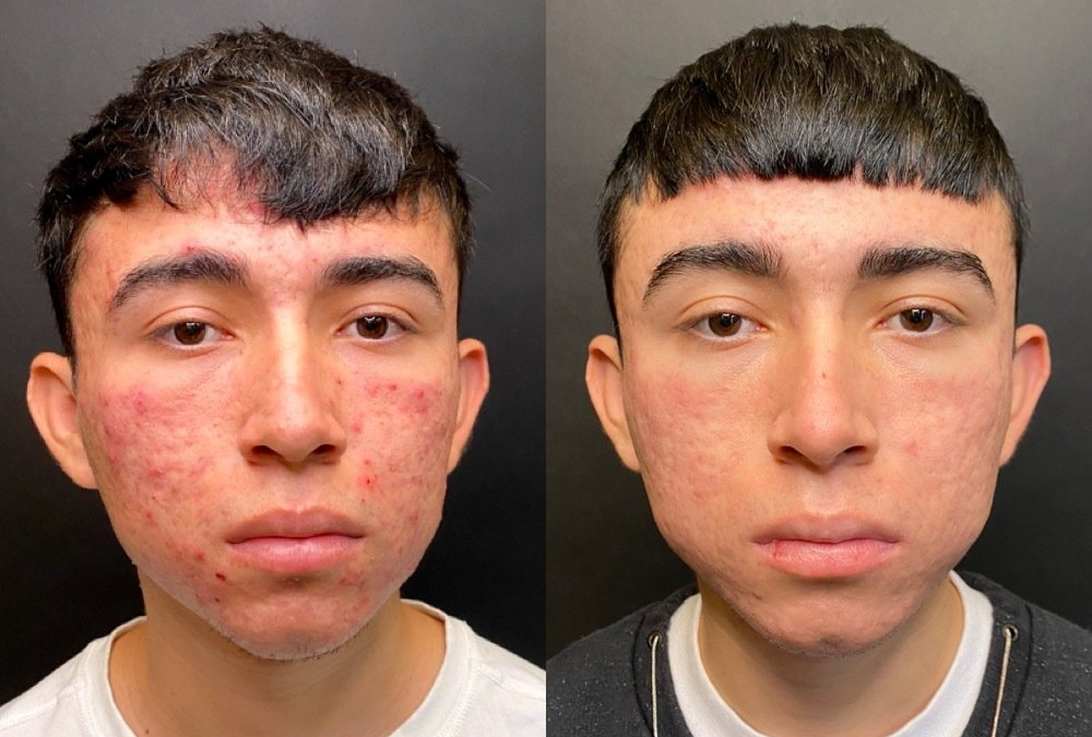 Clear Skin Acne Treatment Los Angeles & Beverly Hills