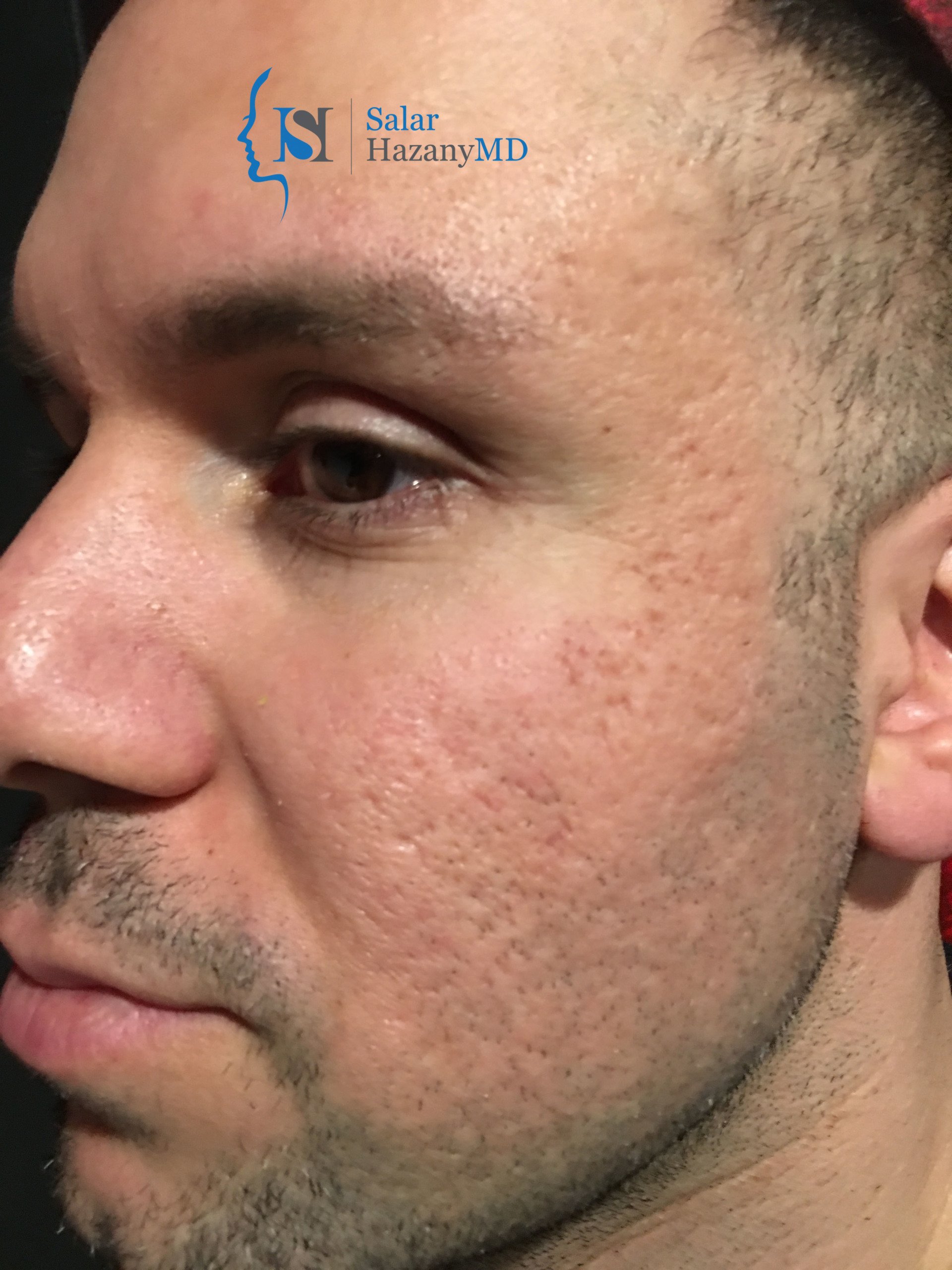 Looking for the World's Best Acne + Acne Scar Doctor?