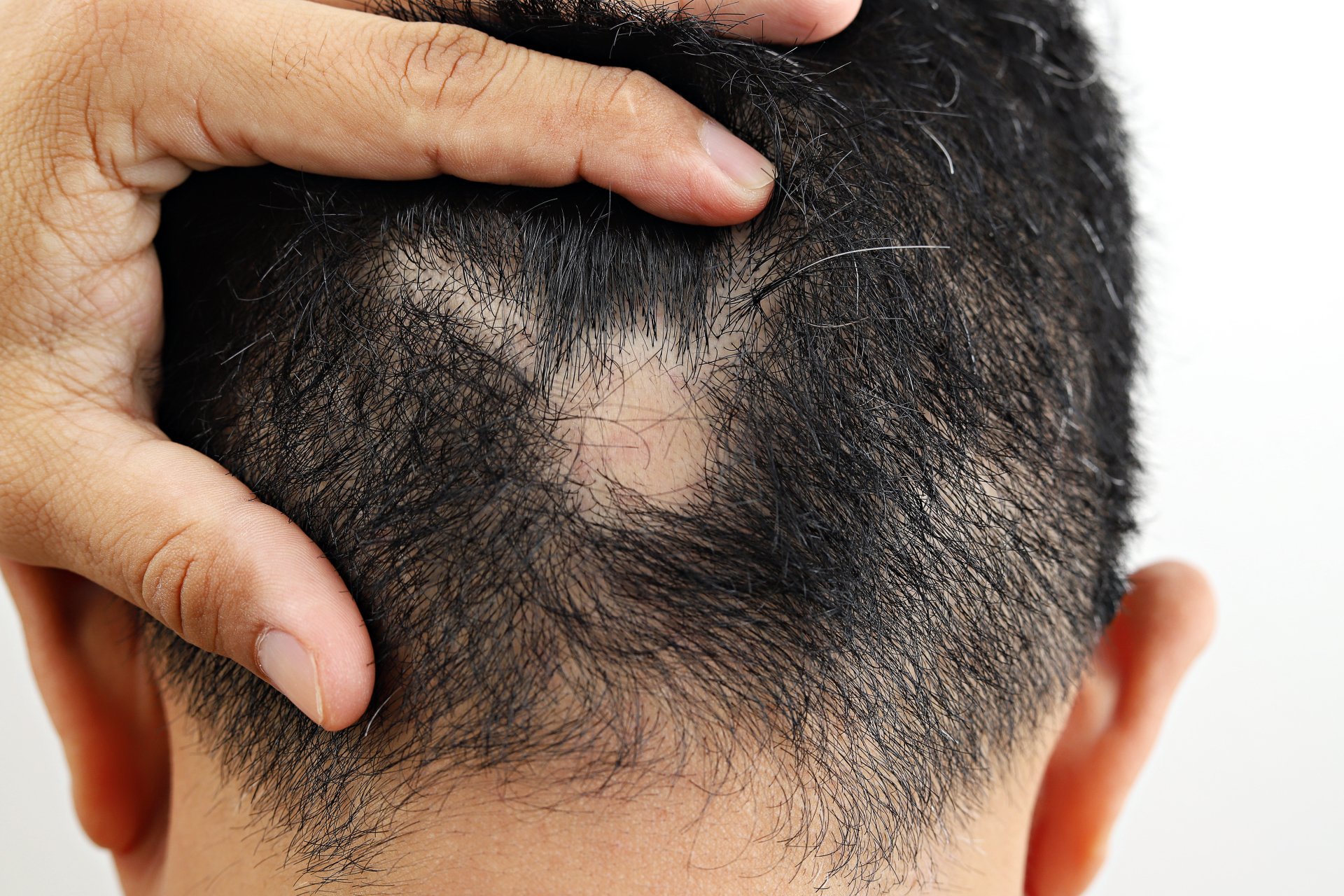 Hair Loss Treatment + Restoration L.A. Hazany MD