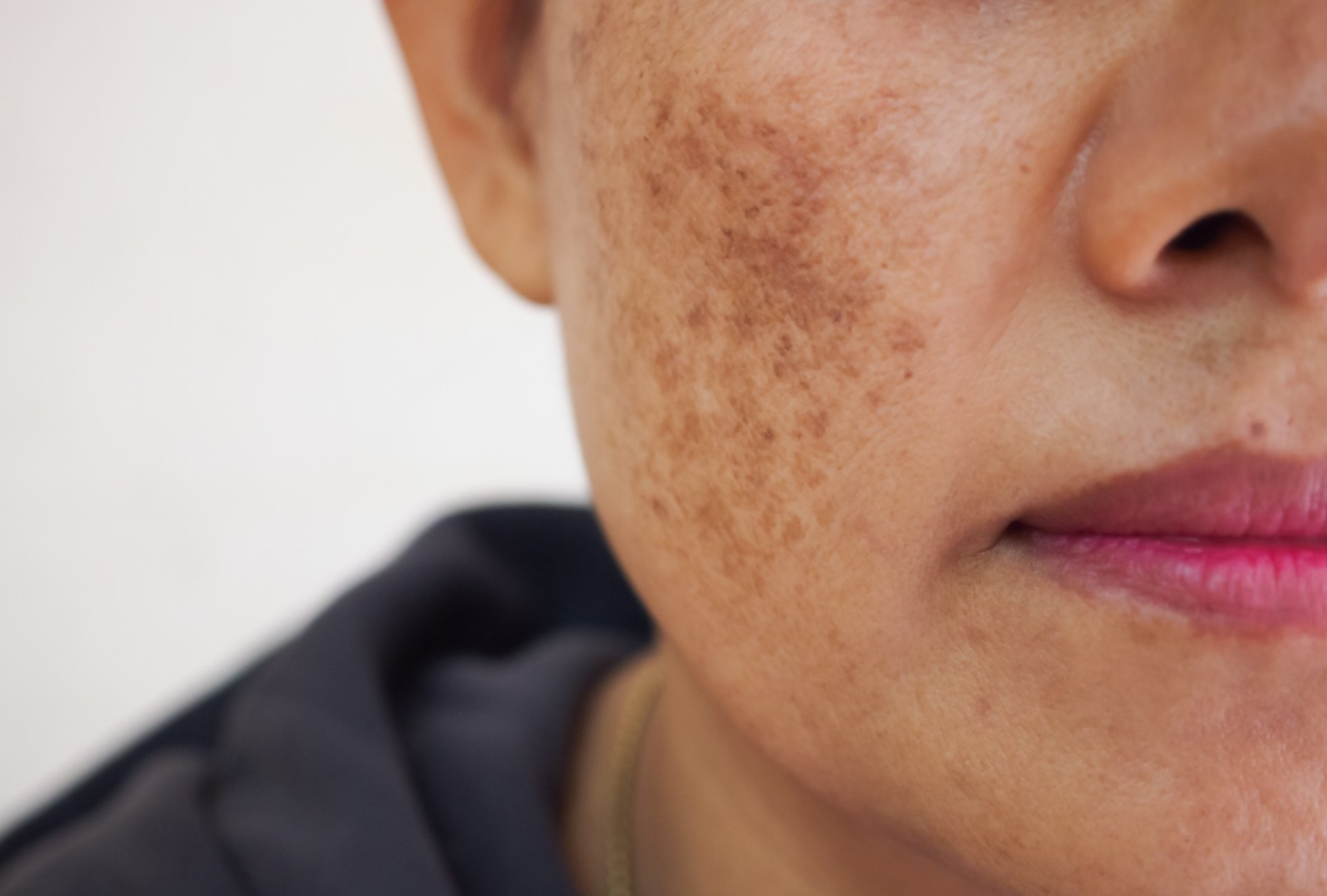 Melasma Treatment + Removal Los Angeles Hazany MD
