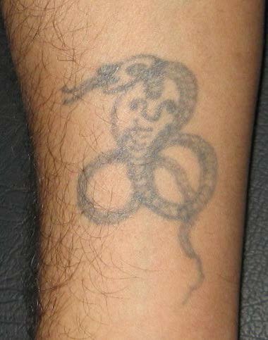 laser tattoo removal tattoo removal at a medical clinic midland laser tattoo removal tattoo removal at a medical clinic midland