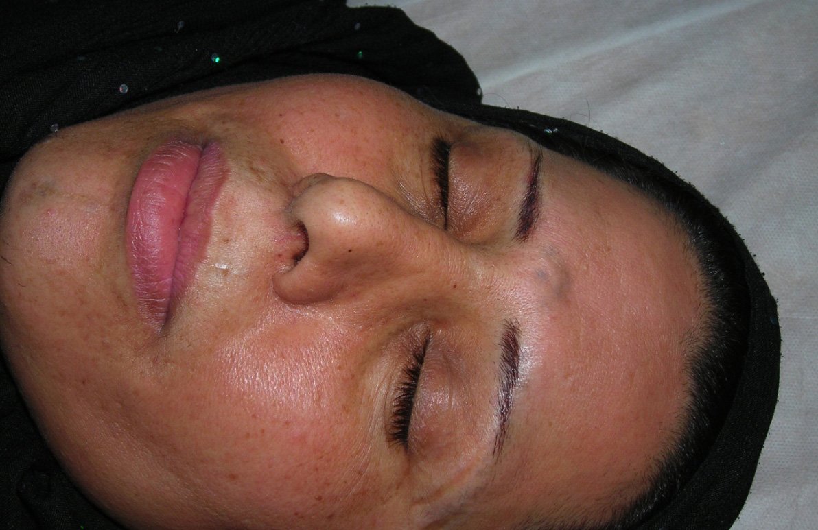 laser tattoo removal tattoo removal at a medical clinic midland laser tattoo removal tattoo removal at a medical clinic midland