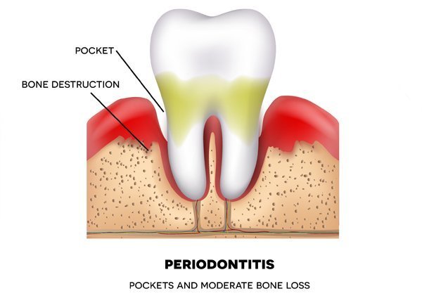 10 Facts About Periodontitis bhzP1x08TteYkbj9lnSm