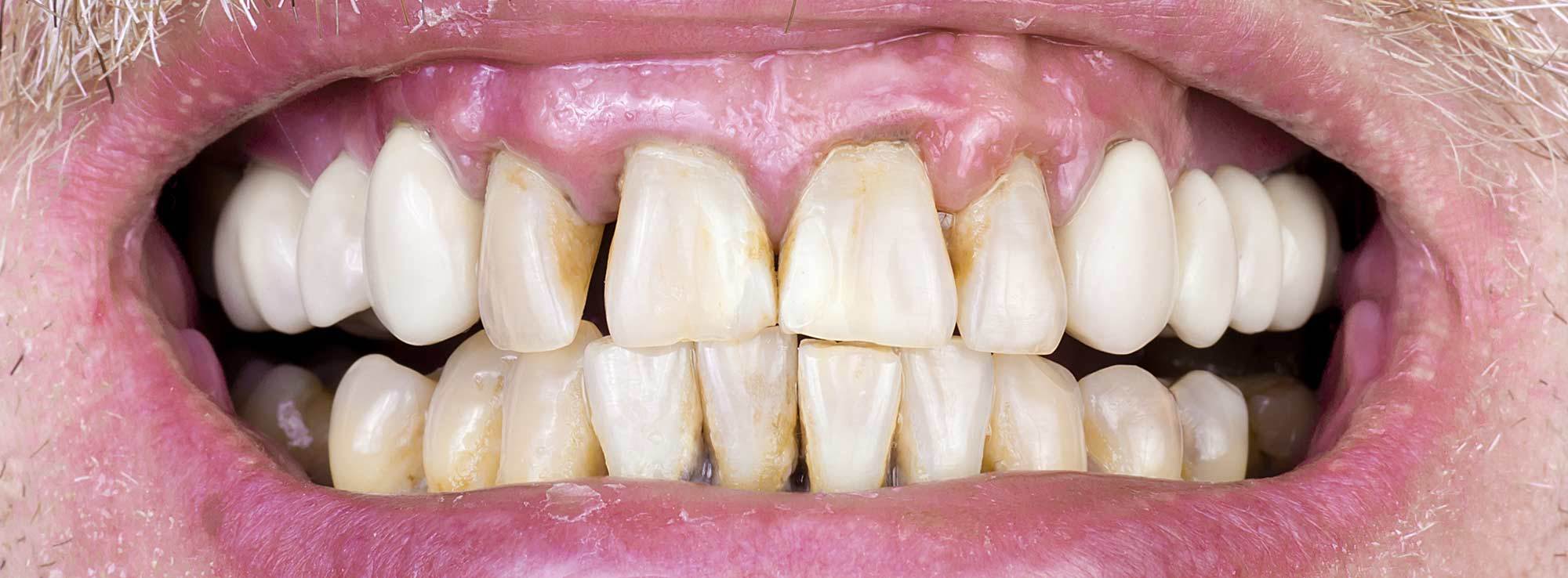 Receding Gum Treatment Dr. Marichia Attalla DDS, PC