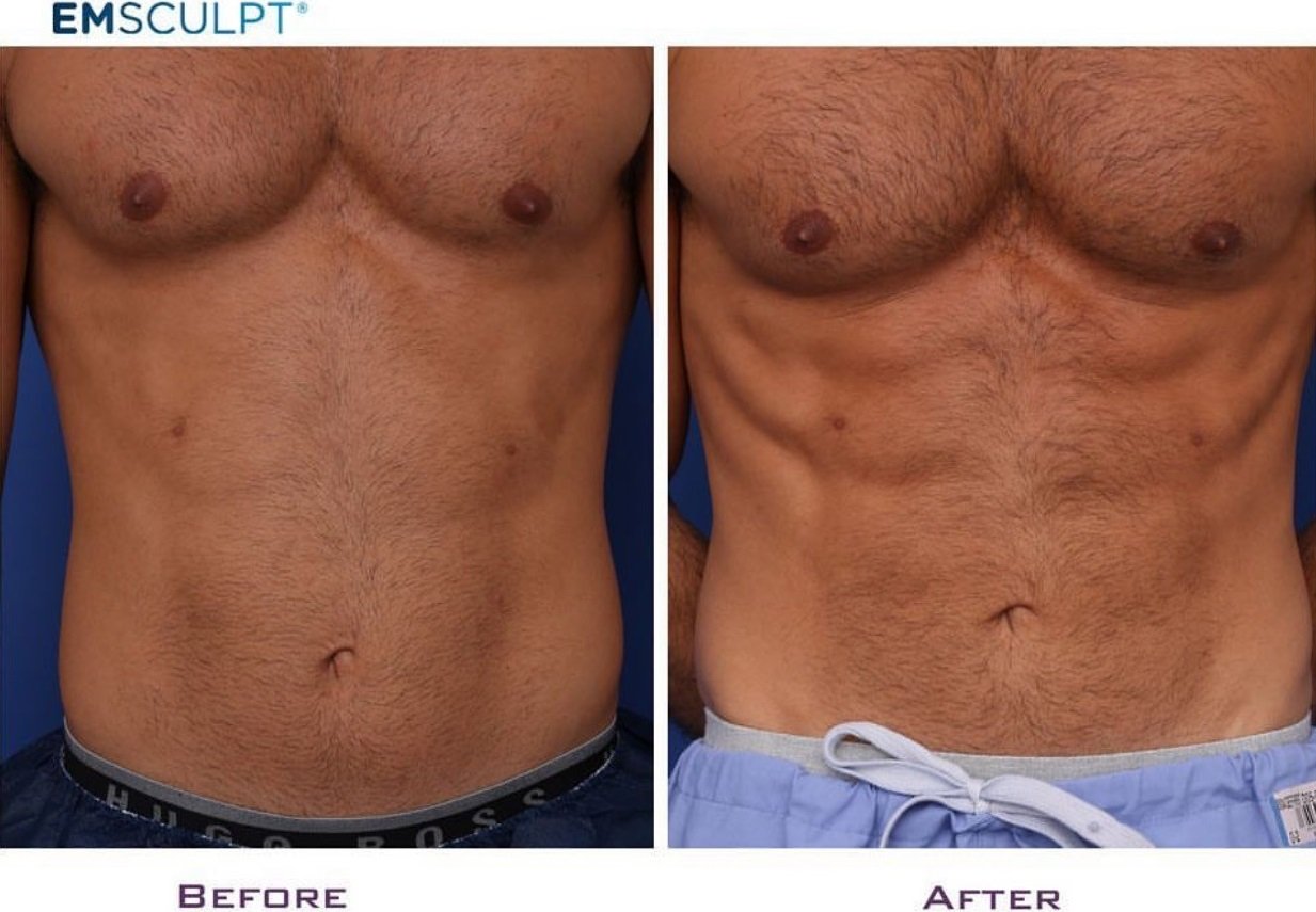Before & After Vein & Aesthetic Treatments Ellicottville, NY DiMarco