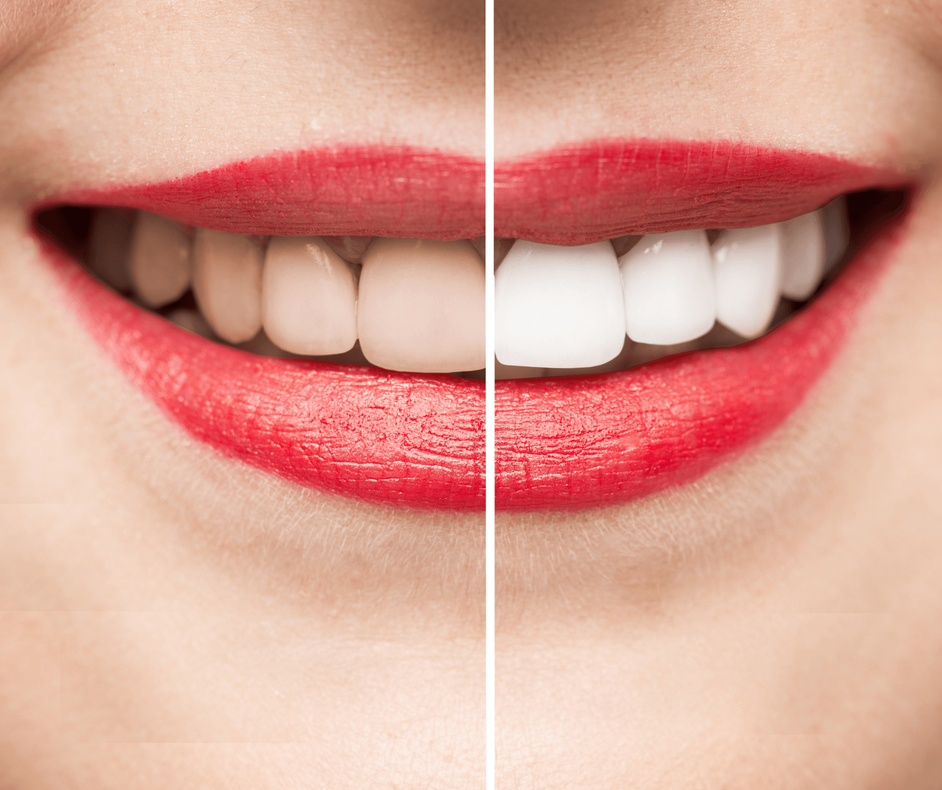 What to Expect When You Get Your Teeth Whitened Professionally