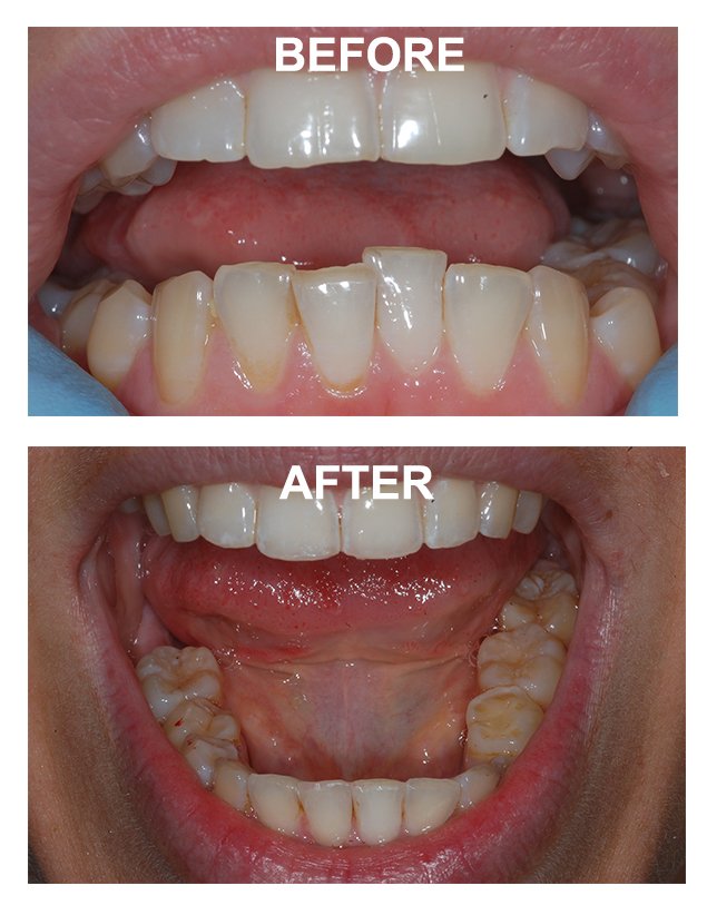 Tooth Bonding Saltash Root Canal Cosmetic Dentist Plymouth