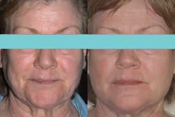 Understanding Cataract Surgery