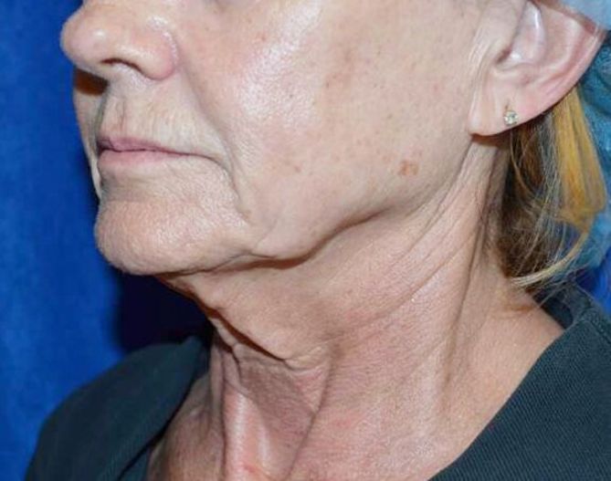Fractional CO2 Face Laser Treatment in the Boston and Providence Area