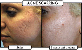 before and after acne scar treatment