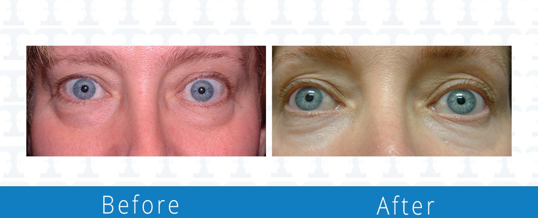 Eyelid surgery before & after  Beaches Facial Plastic & Nasal Surgery Center - the top surgeon for a blepharoplasty or eyelid surgery in Jacksonville or Northeast Florida.