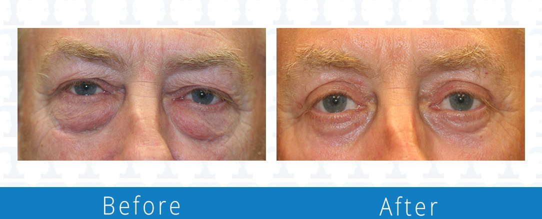 Eyelid surgery before & after  Beaches Facial Plastic & Nasal Surgery Center - the top surgeon for a blepharoplasty or eyelid surgery in Jacksonville or Northeast Florida.