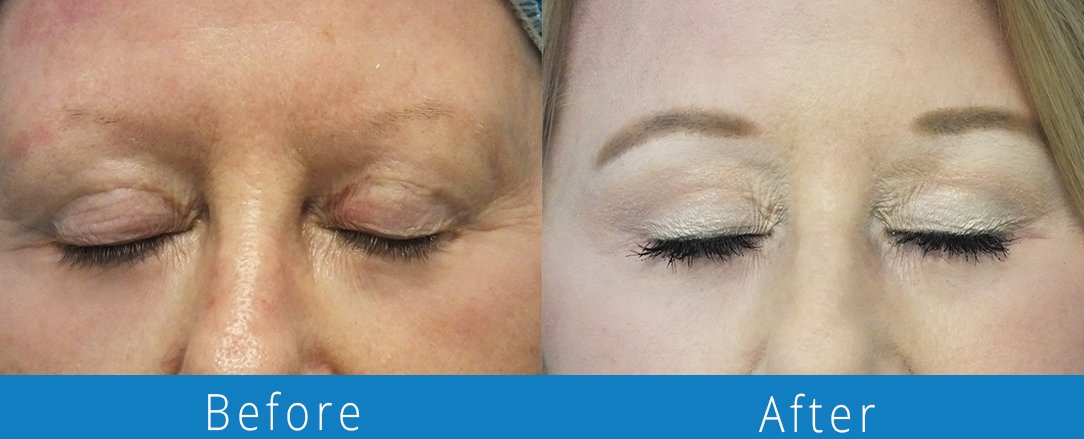 Eyelid surgery before & after  Beaches Facial Plastic & Nasal Surgery Center - the top surgeon for a blepharoplasty or eyelid surgery in Jacksonville or Northeast Florida.