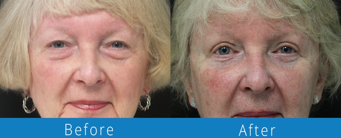 Eyelid surgery before & after  Beaches Facial Plastic & Nasal Surgery Center - the top surgeon for a blepharoplasty or eyelid surgery in Jacksonville or Northeast Florida.