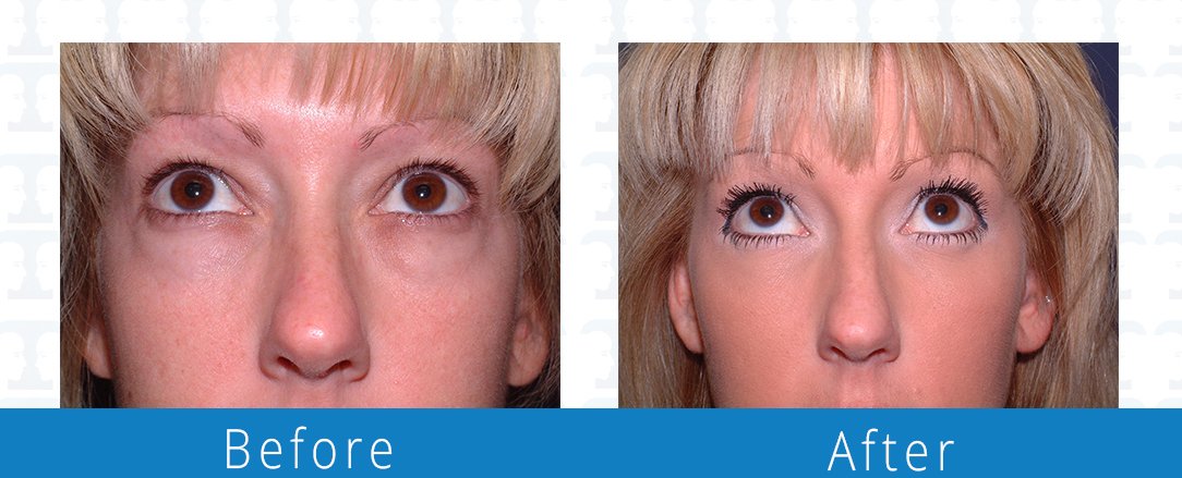 Eyelid surgery before & after  Beaches Facial Plastic & Nasal Surgery Center - the top surgeon for a blepharoplasty or eyelid surgery in Jacksonville or Northeast Florida.