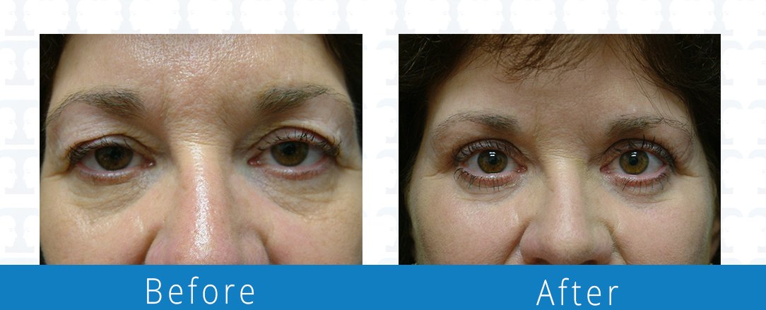 Eyelid surgery before & after Beaches Facial Plastic & Nasal Surgery Center - the top surgeon for a blepharoplasty or eyelid surgery in Jacksonville or Northeast Florida.