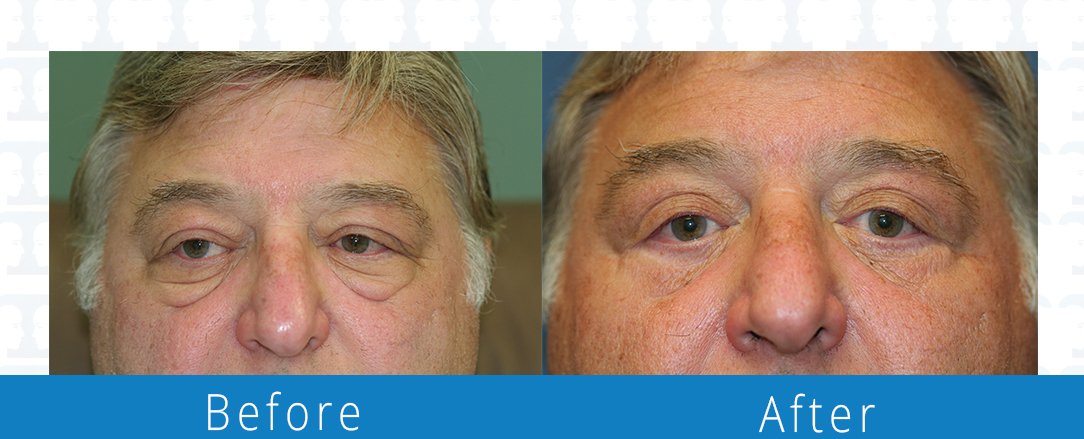 Eyelid surgery before & after  Beaches Facial Plastic & Nasal Surgery Center - the top surgeon for a blepharoplasty or eyelid surgery in Jacksonville or Northeast Florida.