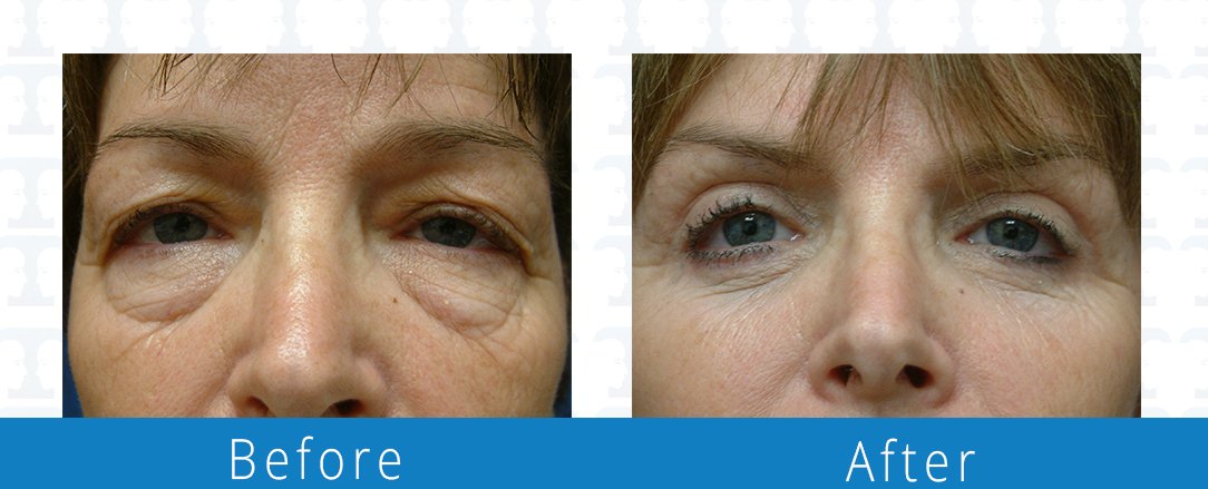 Eyelid surgery before & after  Beaches Facial Plastic & Nasal Surgery Center - the top surgeon for a blepharoplasty or eyelid surgery in Jacksonville or Northeast Florida.