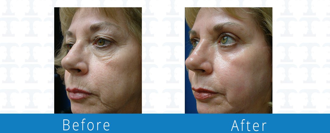 Eyelid surgery before & after  Beaches Facial Plastic & Nasal Surgery Center - the top surgeon for a blepharoplasty or eyelid surgery in Jacksonville or Northeast Florida.