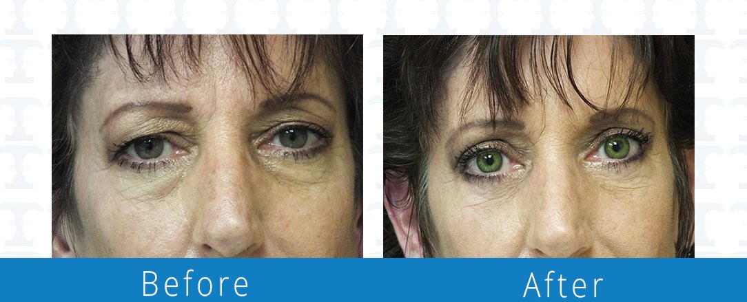 Eyelid surgery before & after  Beaches Facial Plastic & Nasal Surgery Center - the top surgeon for a blepharoplasty or eyelid surgery in Jacksonville or Northeast Florida.