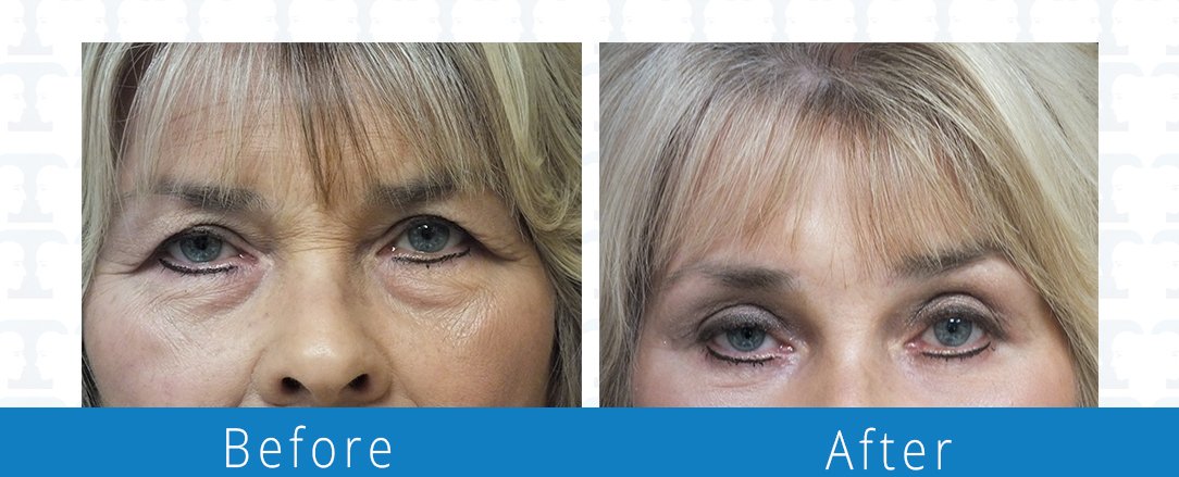 Eyelid surgery before & after  Beaches Facial Plastic & Nasal Surgery Center - the top surgeon for a blepharoplasty or eyelid surgery in Jacksonville or Northeast Florida.