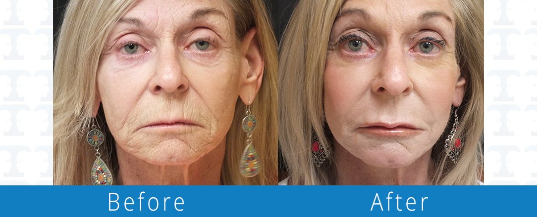Juvaderm before & after from Beaches Facial Plastic Surgery - the top place for juvaderm dermal fillers treatment in Jacksonville or Northeast Florida. 