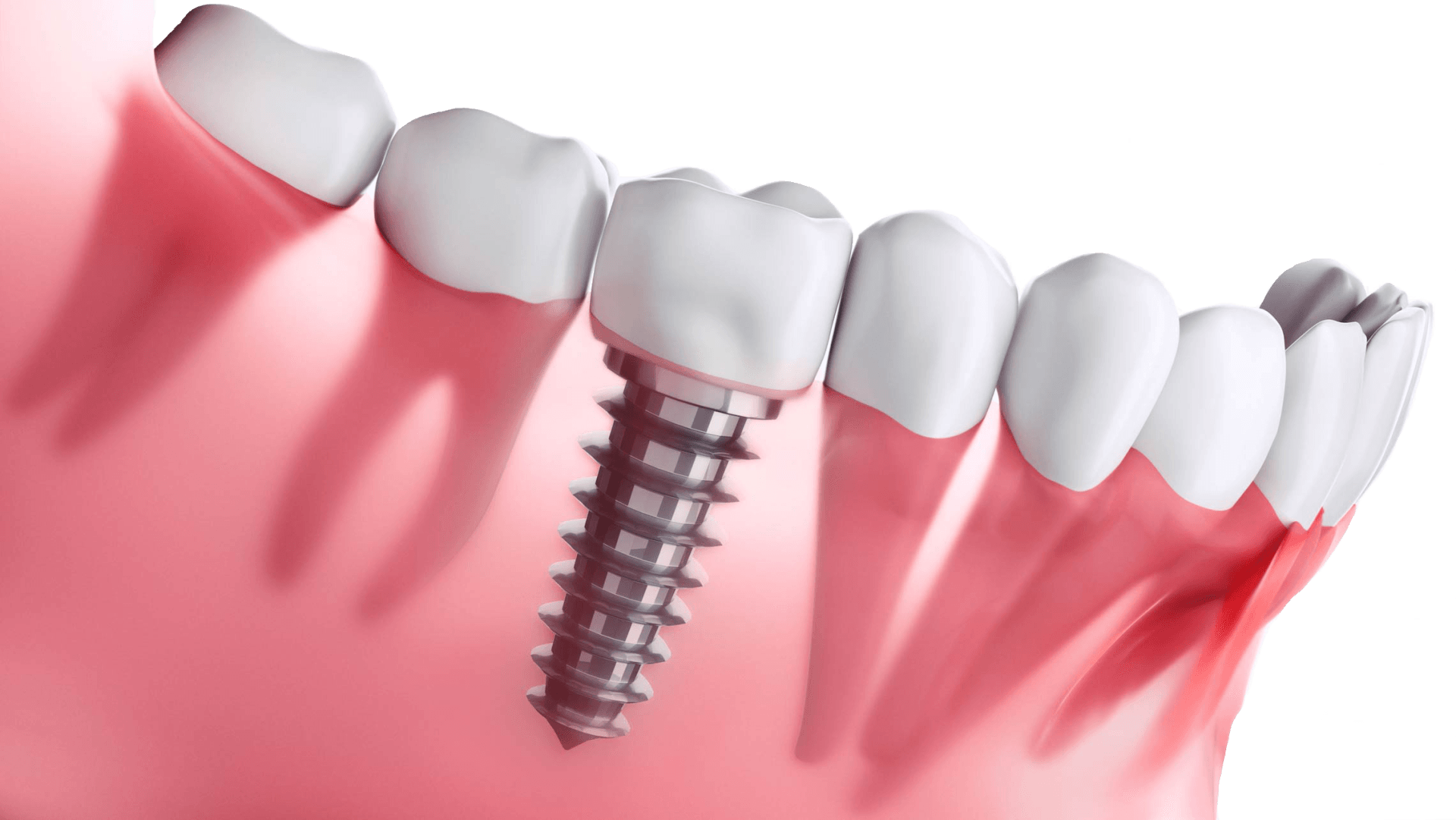 O QUE S O IMPLANTES DENT RIOS 