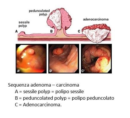 dieta post polipectomia endoscopica