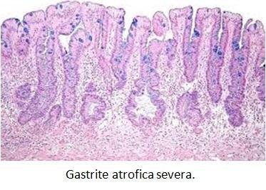 dieta per gastrite iperemica antrale dieta per gastrite iperemica antrale