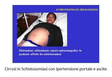gli ossiuri causano sanguinamento gli ossiuri causano sanguinamento