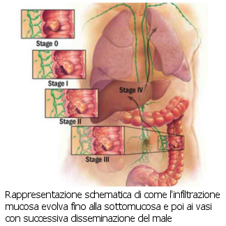 dieta per la chirurgia del cancro del colon
