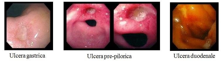 dieta nell ulcera duodenale