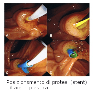 dieta gastrica per endoscopia