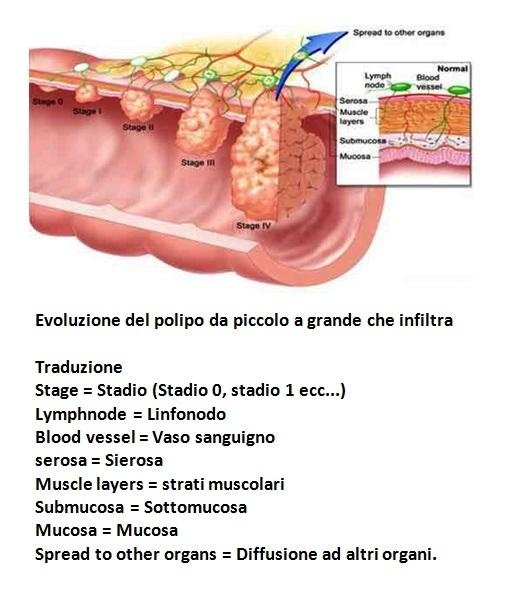 dieta post polipectomia endoscopica dieta post polipectomia endoscopica