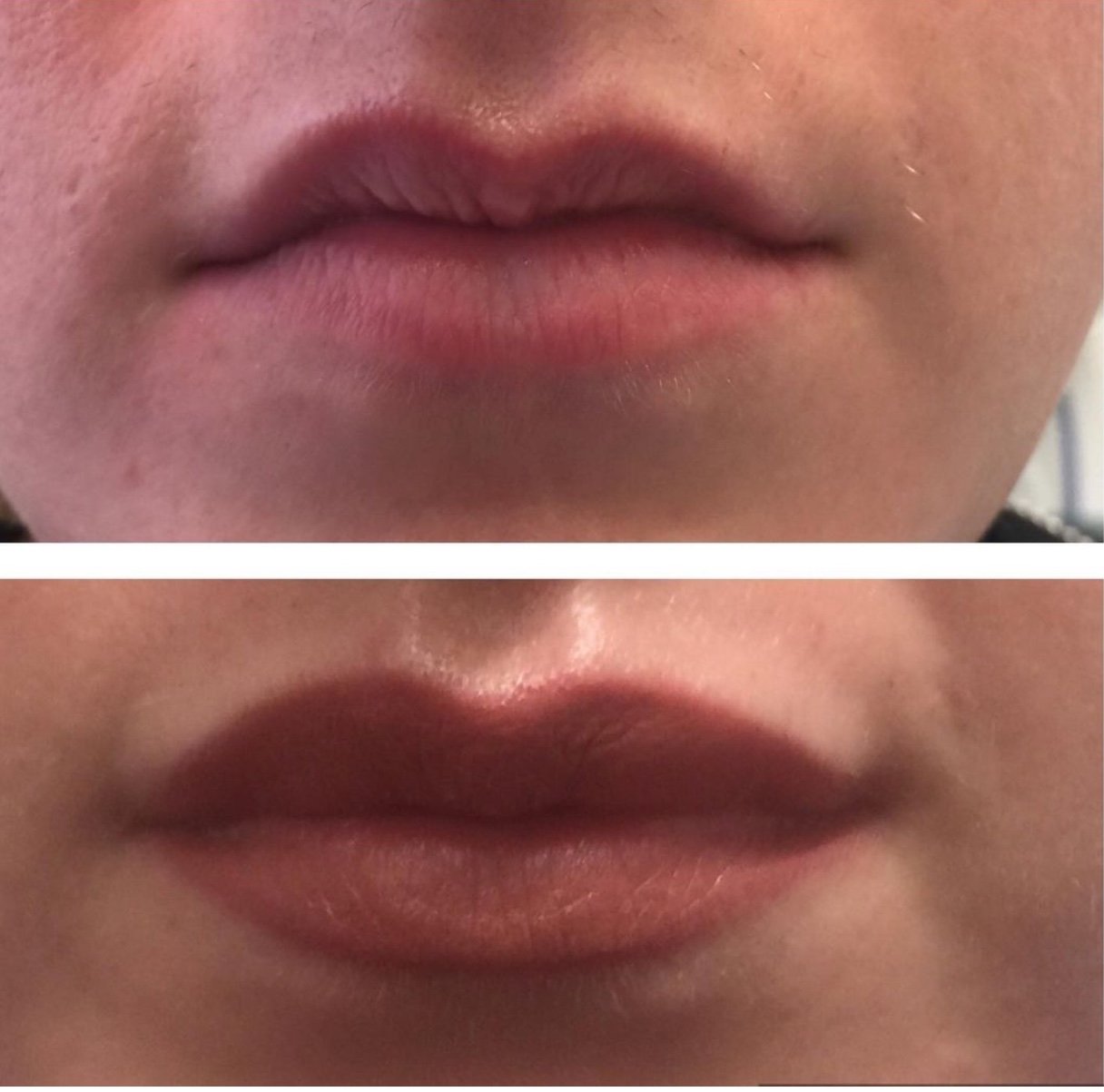 Dermal Fillers Facial Line Softening