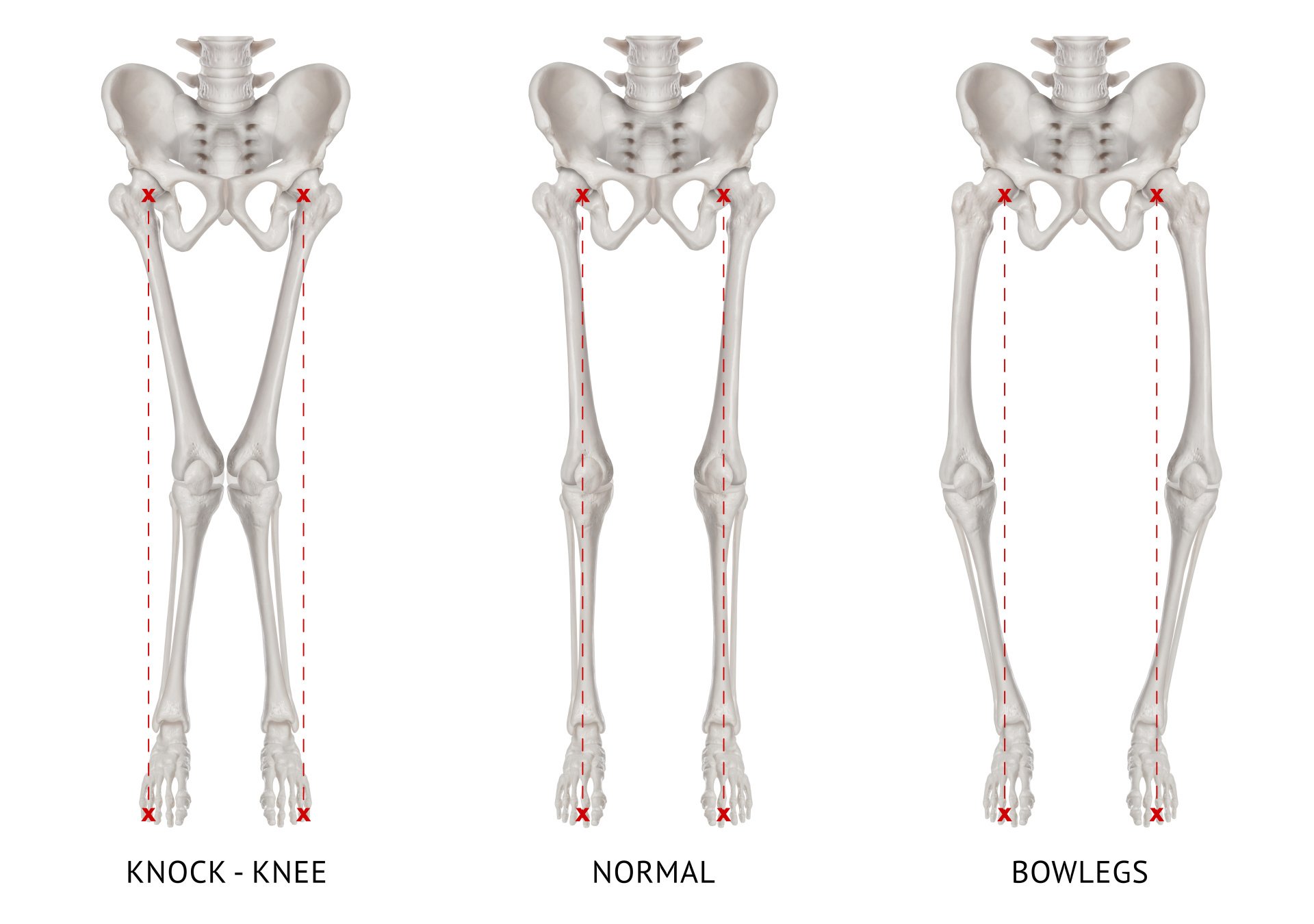 Lower Limb Malalignment Symptoms and Treatment