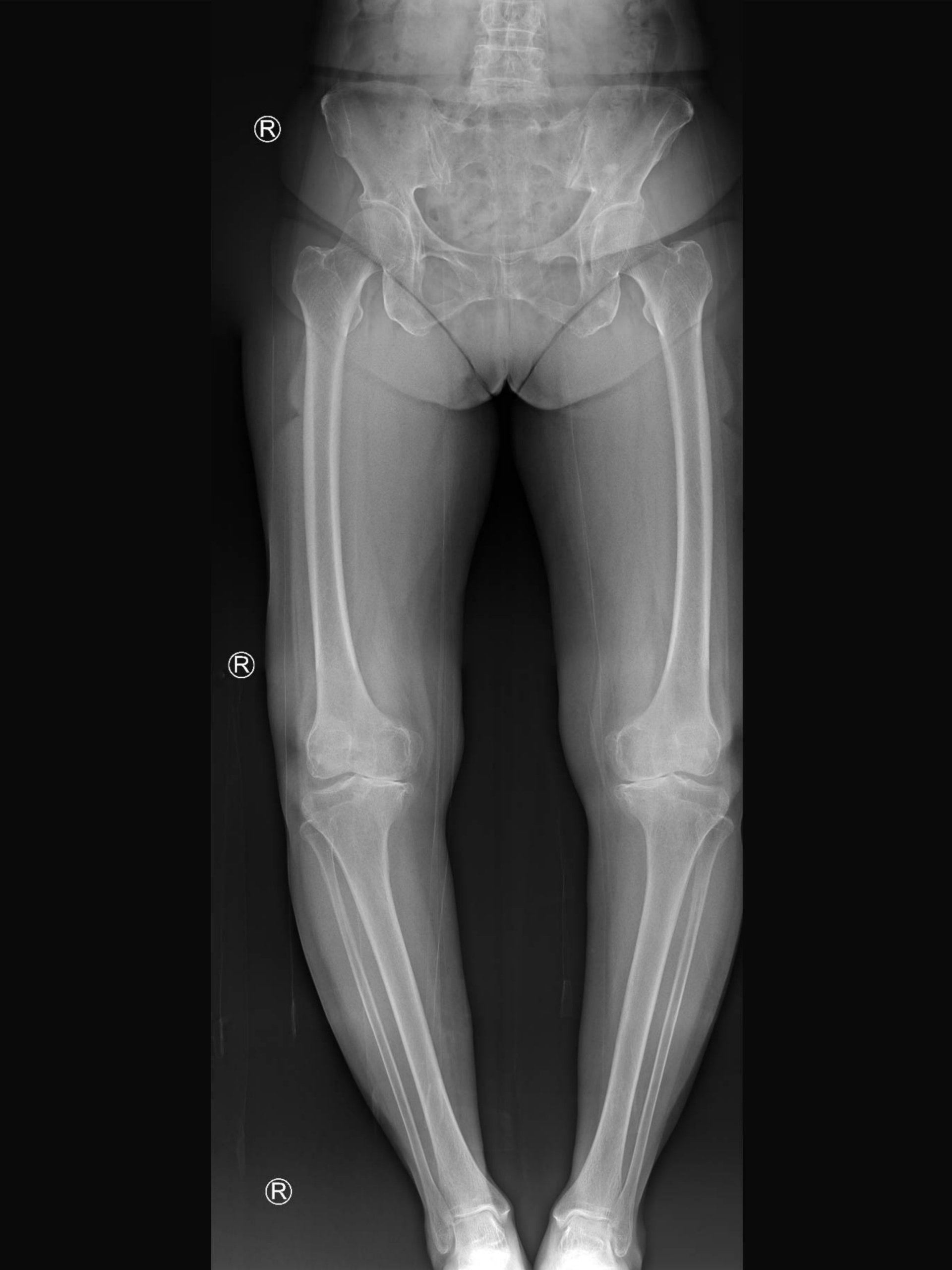 Knee Realignment Osteotomies | Dr A. Theodorides Knee Surgeon