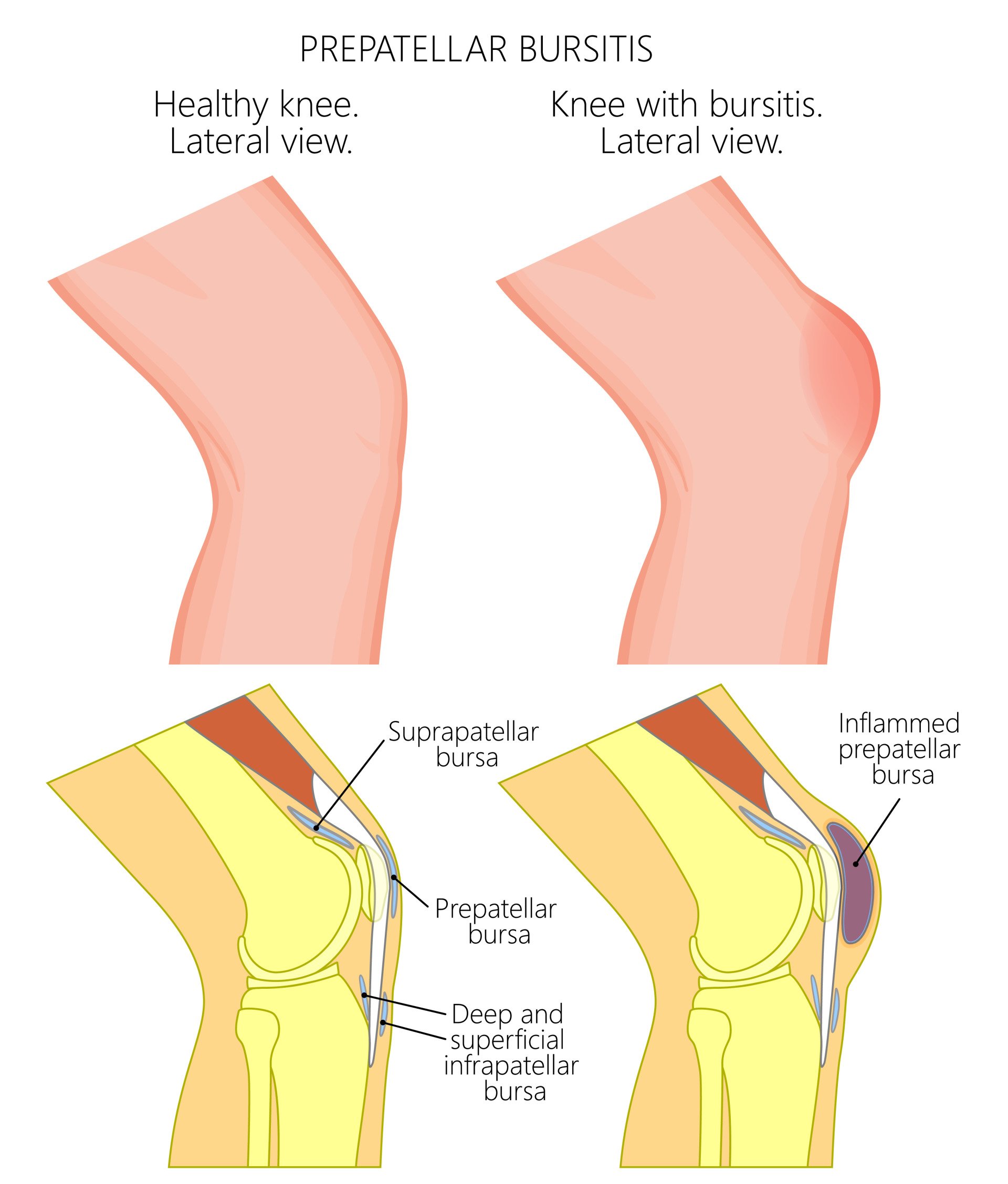 Bursitis | Knee Surgeon Dr A Theodorides - Symptoms, Diagnosis, Treatment
