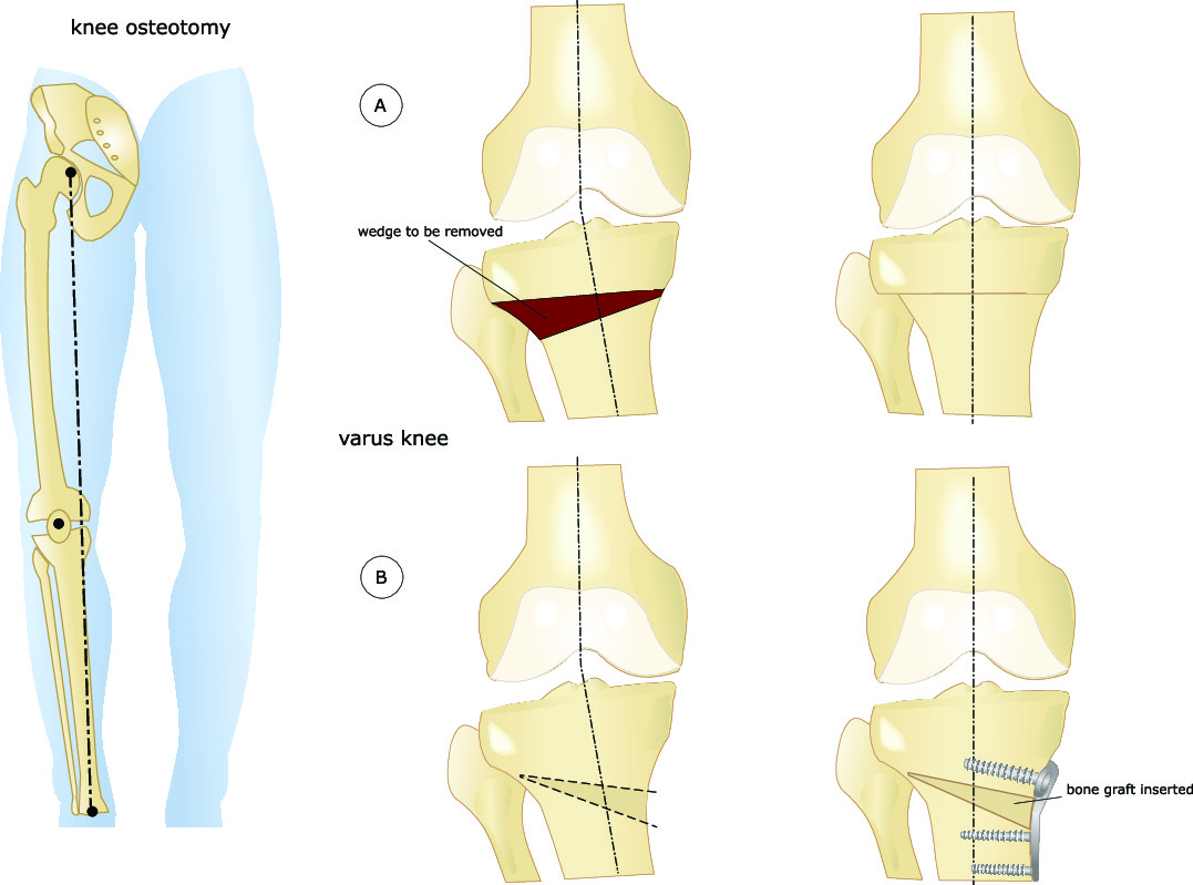 Varus Rotation Osteotomy Knee Realignment Osteotomies | Dr A. Theodorides Knee Surgeon