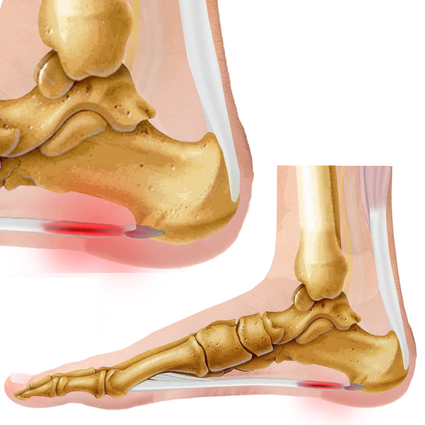 flat feet pain in heel