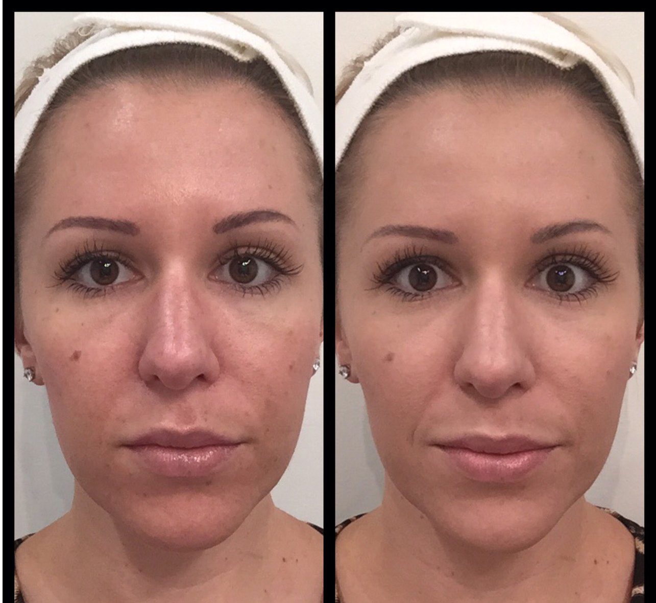 Why Fundations Is the Hidden Key to Flawless Skin, No More Struggle