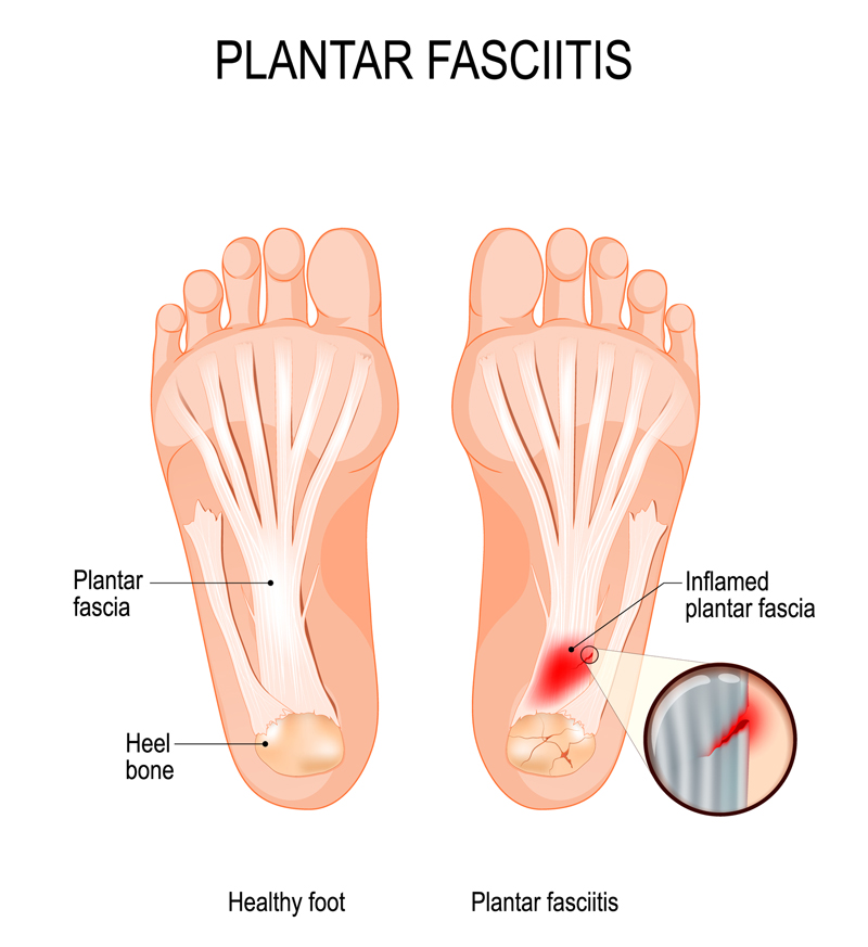Plantar Fasciitis Massage Therapy Suffolk County NY