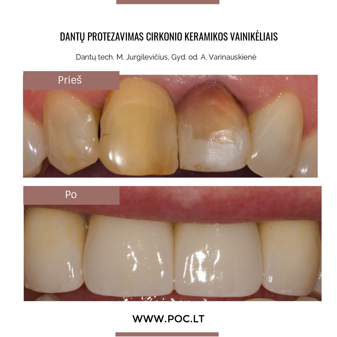 Dantų protezavimas Klaipėda Poc.lt