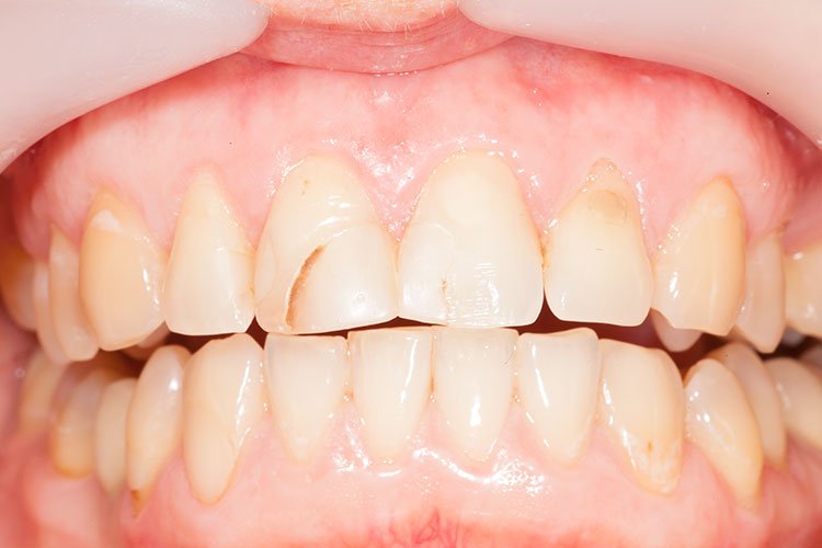 Dantų protezavimas Klaipėda Poc.lt