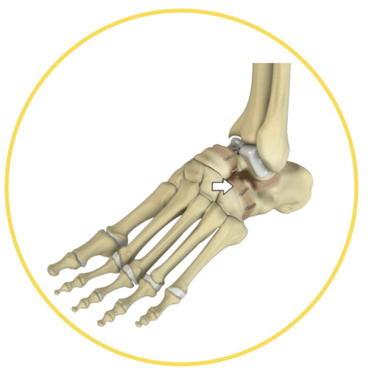 Ankle Fusion Surgery Bunbury Foot & Ankle Surgeon