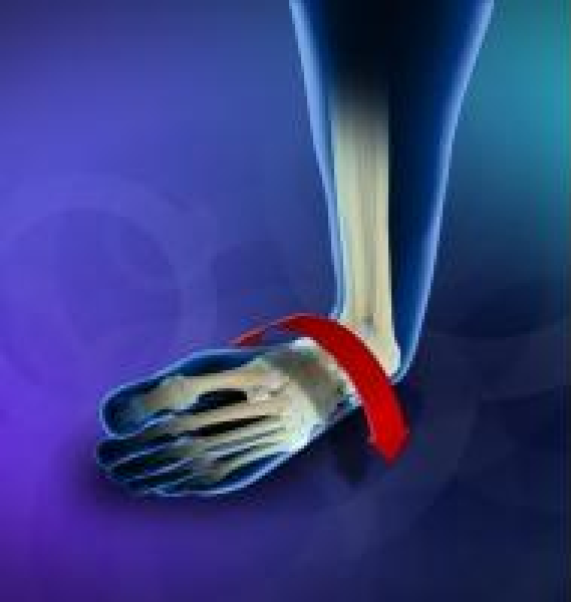 Ankle Instability Bunbury Foot & Ankle Surgeon