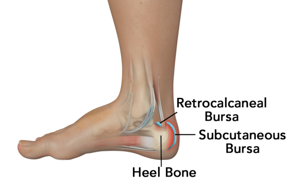 Achilles Tendon Bursitis Bunbury Foot Ankle Surgeon